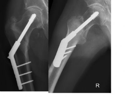 Osteonics Omega Hip Screw (Implant 15)